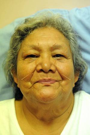 acupuncture-sur-une-femme-lakota-sioux_original